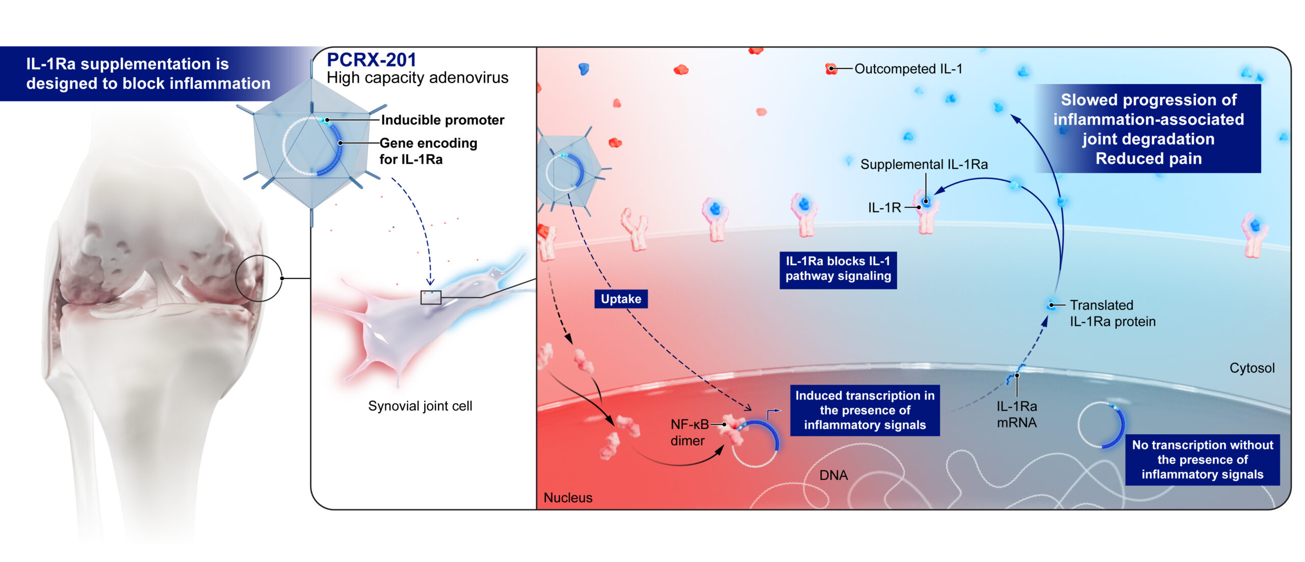 Illustration showing how PCRX-201 could inhibit IL-1 signaling, dampening chronic inflammation in the knee.