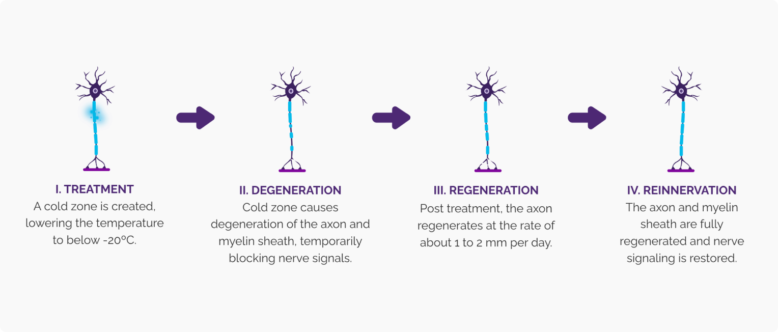 Diagram of nerve stages when using iovera: cold therapy, degeneration, regeneration and restored signaling.