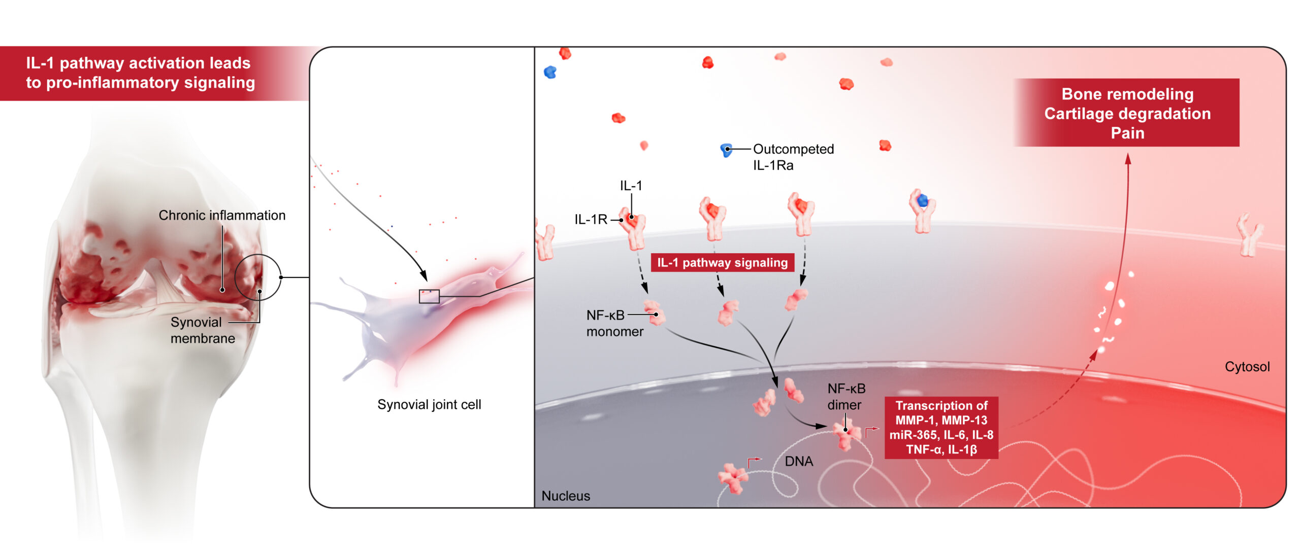 Illustration showing how IL-1-driven inflammation can cause bone remodeling, cartilage degration and pain in the knee.